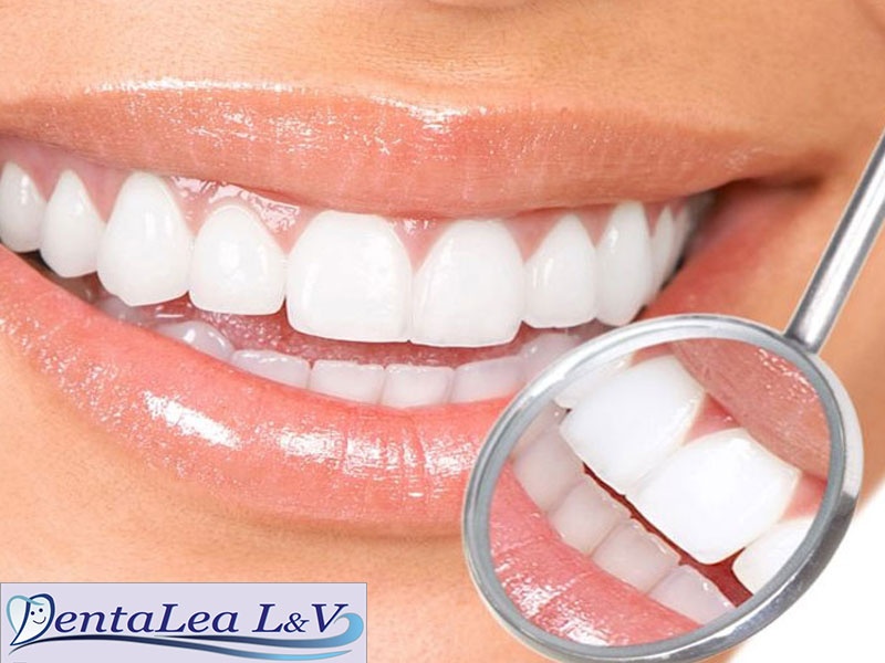 Ласерско белеење на заби (два третмани) + полирање