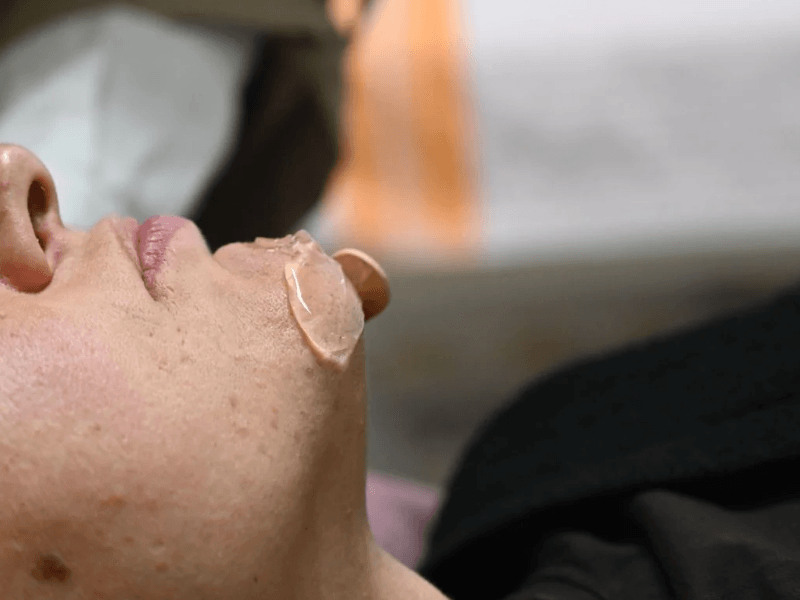 Ласерска Епилација на брада во Центар за естетика и козметологија „Beauty room S“